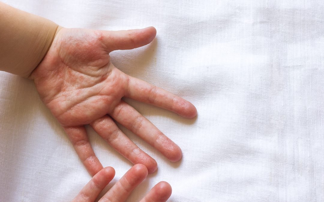 How Long Does Hand, Foot, & Mouth Disease Last?